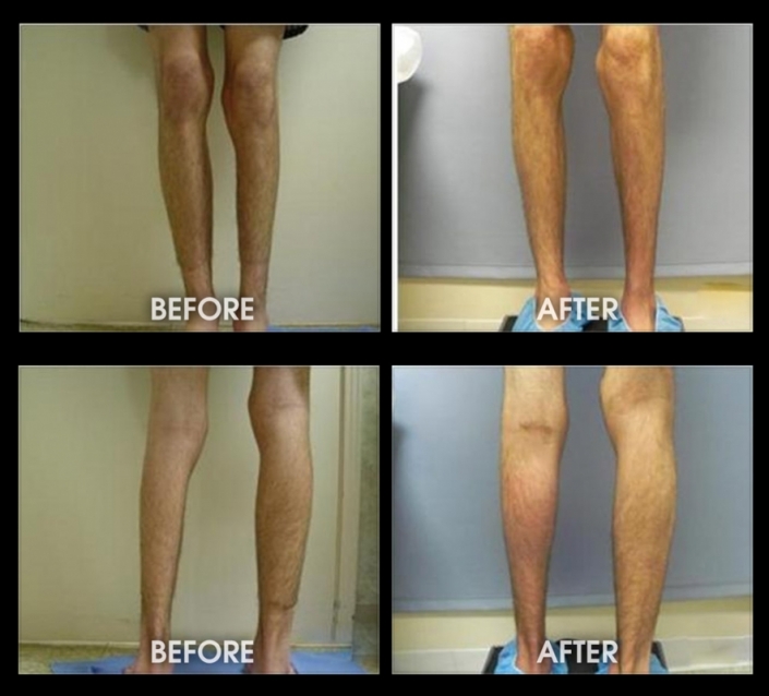Male Calf Implants Before and After Photos, Los Angeles