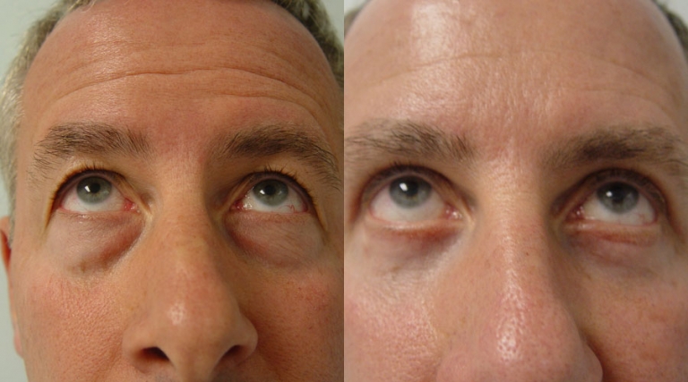 Male Blepharoplasty Eyelid Surgery Before And After Photos Los Angeles